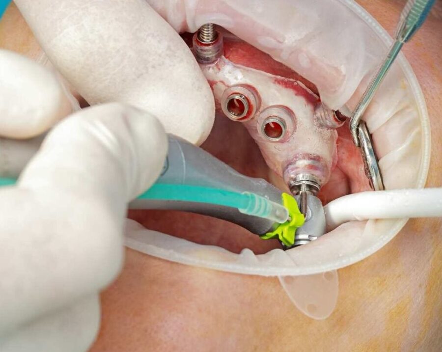 「微創植牙」是屬於比較新式的植牙手術方式，相較於傳統的手術方式，微創植牙無需開刀將牙肉翻開，因此造成的傷口較小，手術後的痛楚也大大減輕。 配合3D掃描（CBCT）以及電腦導航技術，牙醫能準確計劃植體位置，利用度身訂造的手術導航器（Surgical Guide）放置植體，使手術風險減低，過程需時更短。 與傳統植牙相同，都需等待3個月以上的時間，讓骨頭與植體整合，才能裝上牙冠。微創植牙費用