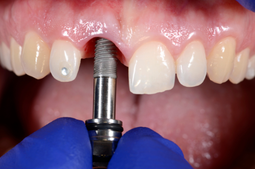 牙醫會為手術位置進行局部麻醉，視乎個別情況而定，採用微創植牙手術只要大約15-20分鐘即可完成單顆植牙手術。當鈦金屬植體植入牙槽骨後，你需等待三個月的時間，讓骨頭與植體整合，才能裝上牙冠。