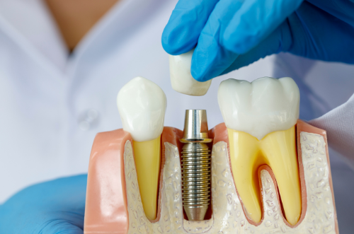 植牙費用三個月後，醫生會幫你印牙模製作牙冠或牙橋。如進行全頜植牙，就需要額外診次數，去製作全口牙橋。